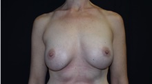 Breast Augmentation After Photo by Robert Kessler, MD; Corona Del Mar, CA - Case 38398