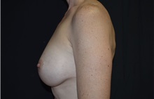 Breast Augmentation After Photo by Robert Kessler, MD; Corona Del Mar, CA - Case 38398