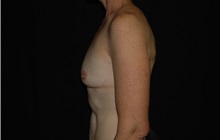 Breast Augmentation Before Photo by Robert Kessler, MD; Corona Del Mar, CA - Case 38398