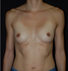 Breast Augmentation Before Photo by Robert Kessler, MD; Corona Del Mar, CA - Case 38770