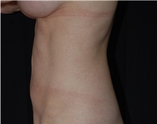 Liposuction After Photo by Robert Kessler, MD; Corona Del Mar, CA - Case 41623