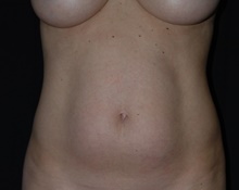 Liposuction Before Photo by Robert Kessler, MD; Corona Del Mar, CA - Case 41626