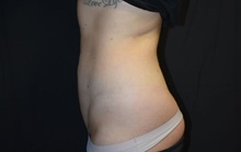 Liposuction After Photo by Robert Kessler, MD; Corona Del Mar, CA - Case 41630