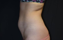 Liposuction Before Photo by Robert Kessler, MD; Corona Del Mar, CA - Case 41630