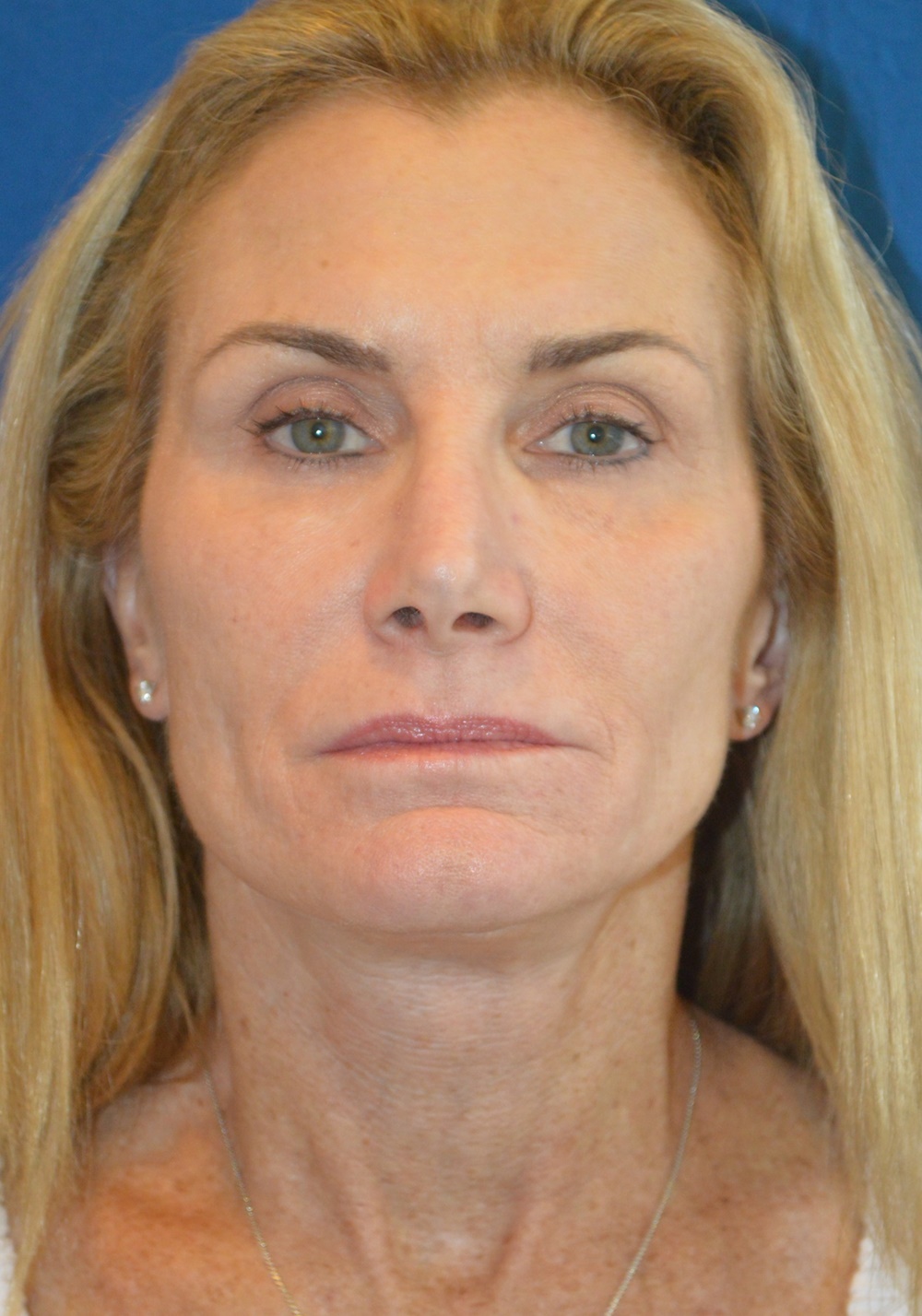 Facelift Before and After Photos by Gregory Albert, MD; Boca Raton, FL