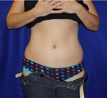 Tummy Tuck After Photo by Daniel Medalie, MD; Beachwood, OH - Case 31460
