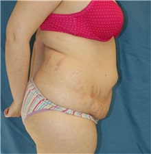 Tummy Tuck Before Photo by Daniel Medalie, MD; Beachwood, OH - Case 31460