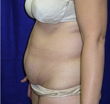 Tummy Tuck Before Photo by Daniel Medalie, MD; Beachwood, OH - Case 31461