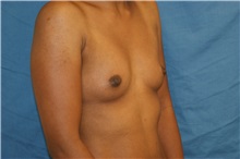 Breast Augmentation Before Photo by Daniel Medalie, MD; Beachwood, OH - Case 31462