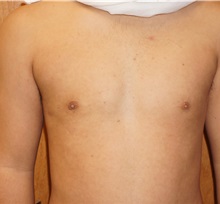 Male Breast Reduction After Photo by Daniel Medalie, MD; Beachwood, OH - Case 31900