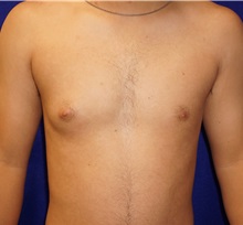 Male Breast Reduction Before Photo by Daniel Medalie, MD; Beachwood, OH - Case 31900