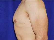 Male Breast Reduction After Photo by Daniel Medalie, MD; Beachwood, OH - Case 31901
