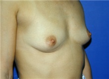 Breast Augmentation Before Photo by Daniel Medalie, MD; Beachwood, OH - Case 3398