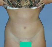 Tummy Tuck After Photo by Daniel Medalie, MD; Beachwood, OH - Case 3597
