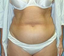 Tummy Tuck Before Photo by Daniel Medalie, MD; Beachwood, OH - Case 3597