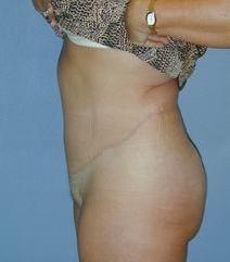 Tummy Tuck After Photo by Daniel Medalie, MD; Beachwood, OH - Case 3597