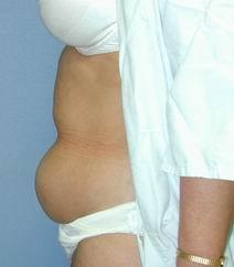 Tummy Tuck Before Photo by Daniel Medalie, MD; Beachwood, OH - Case 3597