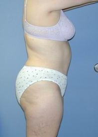 Tummy Tuck After Photo by Daniel Medalie, MD; Beachwood, OH - Case 3617