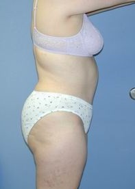 Tummy Tuck in Cleveland, Ohio - Daniel A. Medalie, M.D.