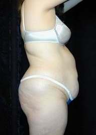 Tummy Tuck Before Photo by Daniel Medalie, MD; Beachwood, OH - Case 3617