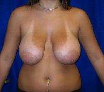 Breast Reduction Before Photo by Daniel Medalie, MD; Beachwood, OH - Case 3794