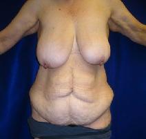 Body Contouring Before Photo by Daniel Medalie, MD; Beachwood, OH - Case 4855