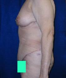 Body Contouring After Photo by Daniel Medalie, MD; Beachwood, OH - Case 4855