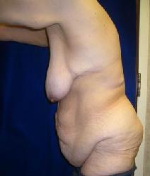 Body Contouring Before Photo by Daniel Medalie, MD; Beachwood, OH - Case 4855