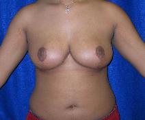 Breast Reduction After Photo by Daniel Medalie, MD; Beachwood, OH - Case 4869