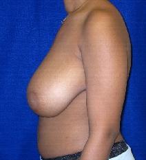 Breast Reduction Before Photo by Daniel Medalie, MD; Beachwood, OH - Case 4869