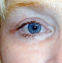 Eyelid Surgery After Photo by Daniel Medalie, MD; Beachwood, OH - Case 4899