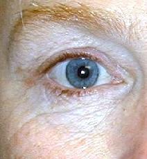 Eyelid Surgery Before Photo by Daniel Medalie, MD; Beachwood, OH - Case 4899