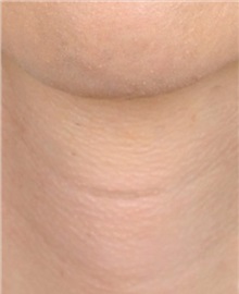 Facial Feminization After Photo by Daniel Medalie, MD; ,  - Case 50239 Facial Feminization After Photo by Daniel Medalie, MD; ,  - Case 50239