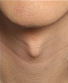 Facial Feminization Before Photo by Daniel Medalie, MD; ,  - Case 50239 Facial Feminization Before Photo by Daniel Medalie, MD; ,  - Case 50239