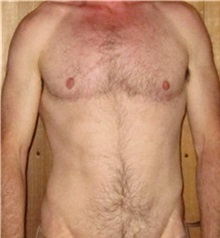 Transmasculine Top Surgery After Photo by Daniel Medalie, MD; ,  - Case 50240 Transmasculine Top Surgery After Photo by Daniel Medalie, MD; ,  - Case 50240