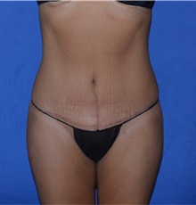 Tummy Tuck After Photo by Karol Gutowski, MD, FACS; Glenview, IL - Case 39108