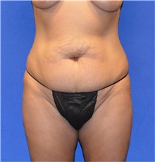 Tummy Tuck Before Photo by Karol Gutowski, MD, FACS; Glenview, IL - Case 39108