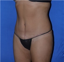 Tummy Tuck After Photo by Karol Gutowski, MD, FACS; Glenview, IL - Case 39108