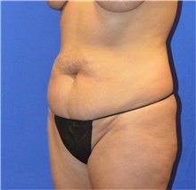 Tummy Tuck Before Photo by Karol Gutowski, MD, FACS; Glenview, IL - Case 39108