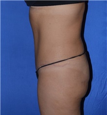 Tummy Tuck After Photo by Karol Gutowski, MD, FACS; Glenview, IL - Case 39108