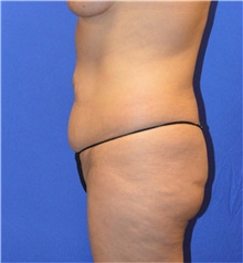 Tummy Tuck Before Photo by Karol Gutowski, MD, FACS; Glenview, IL - Case 39108