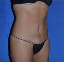 Tummy Tuck After Photo by Karol Gutowski, MD, FACS; Glenview, IL - Case 39108