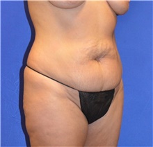 Tummy Tuck Before Photo by Karol Gutowski, MD, FACS; Glenview, IL - Case 39108