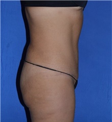 Tummy Tuck After Photo by Karol Gutowski, MD, FACS; Glenview, IL - Case 39108