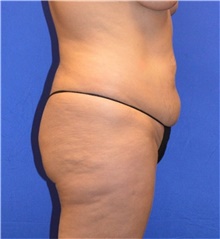 Tummy Tuck Before Photo by Karol Gutowski, MD, FACS; Glenview, IL - Case 39108