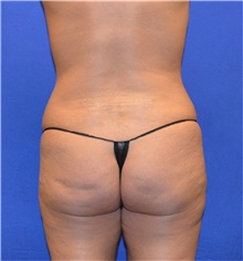 Tummy Tuck Before Photo by Karol Gutowski, MD, FACS; Glenview, IL - Case 39108