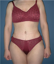 Tummy Tuck After Photo by Karol Gutowski, MD, FACS; Glenview, IL - Case 39109