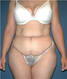 Tummy Tuck Before Photo by Karol Gutowski, MD, FACS; Glenview, IL - Case 39109