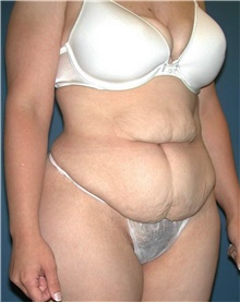 Tummy Tuck Before Photo by Karol Gutowski, MD, FACS; Glenview, IL - Case 39109