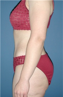 Tummy Tuck After Photo by Karol Gutowski, MD, FACS; Glenview, IL - Case 39109